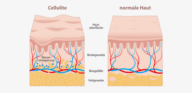 Cellulite